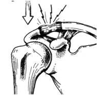 Grade 1 dislocation