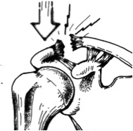 Grade 2 dislocation