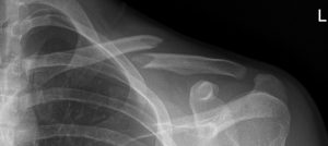 Fracture of the clavicle