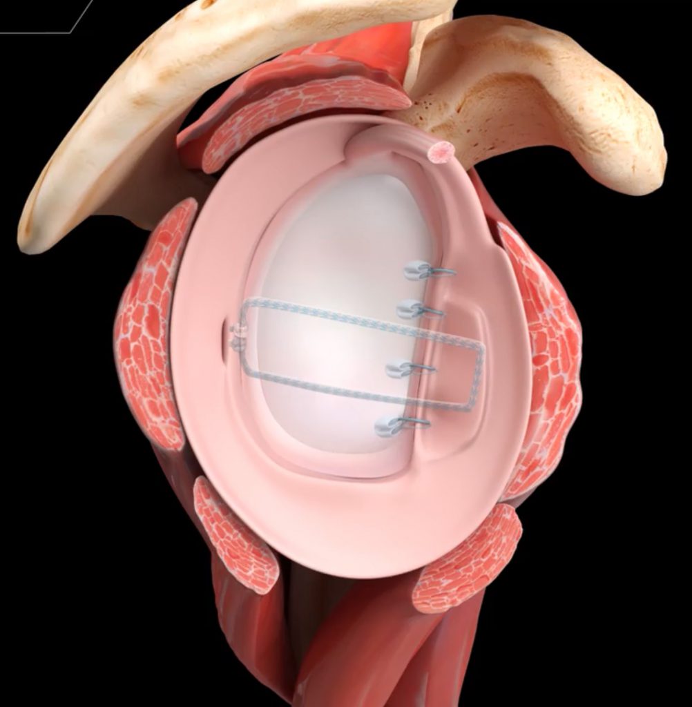 View of glenoid with bone graft and labrum repaired