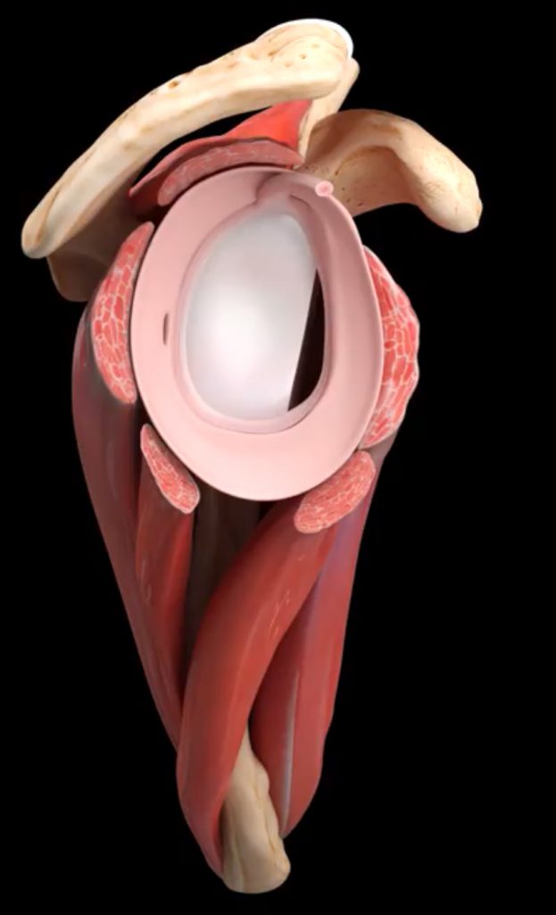 View of glenoid with bone loss