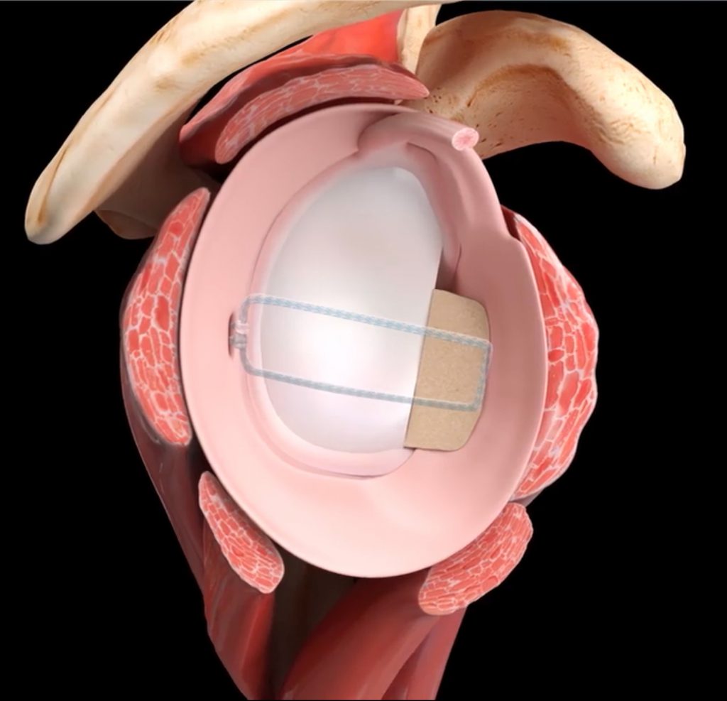 View of glenoid with bone graft in place